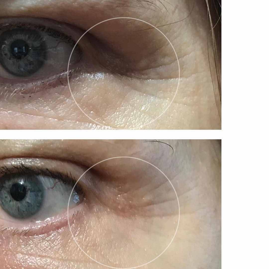 botox-alternative-collagen-before-after-photos