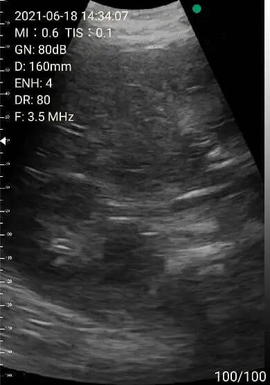 EagleView portable ultrasound image-hepatorenal fossa