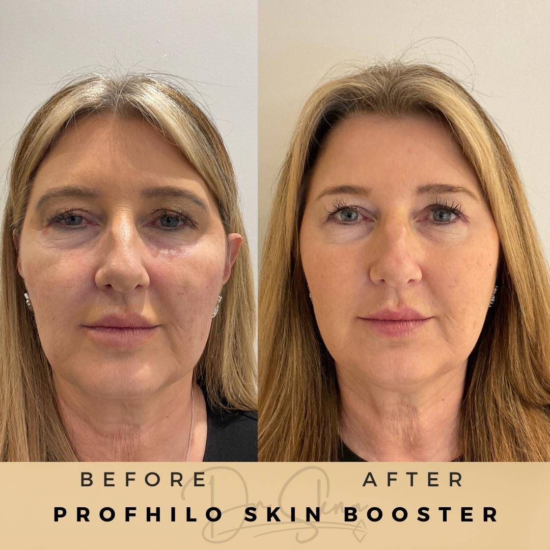Profhilo Wilmslow Before & After Dr Sknn