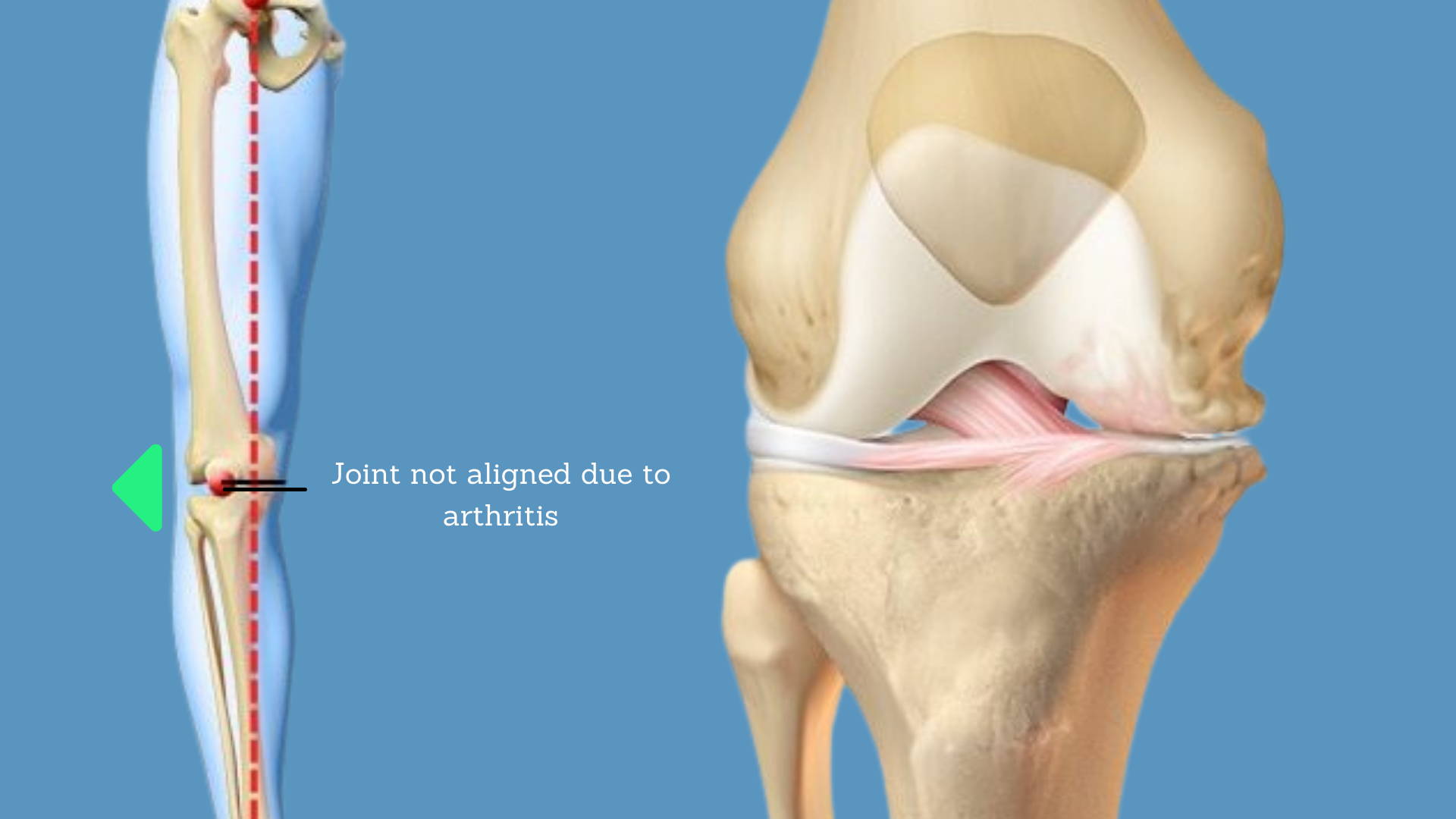 OA Unloader Knee Brace Support Medial or lateral Support