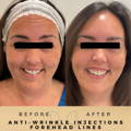 Anti-Wrinkle Injections Wilmslow Before & After Dr Sknn