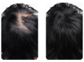 Before and after results of using our best vitamins for hair growth on a man's head
