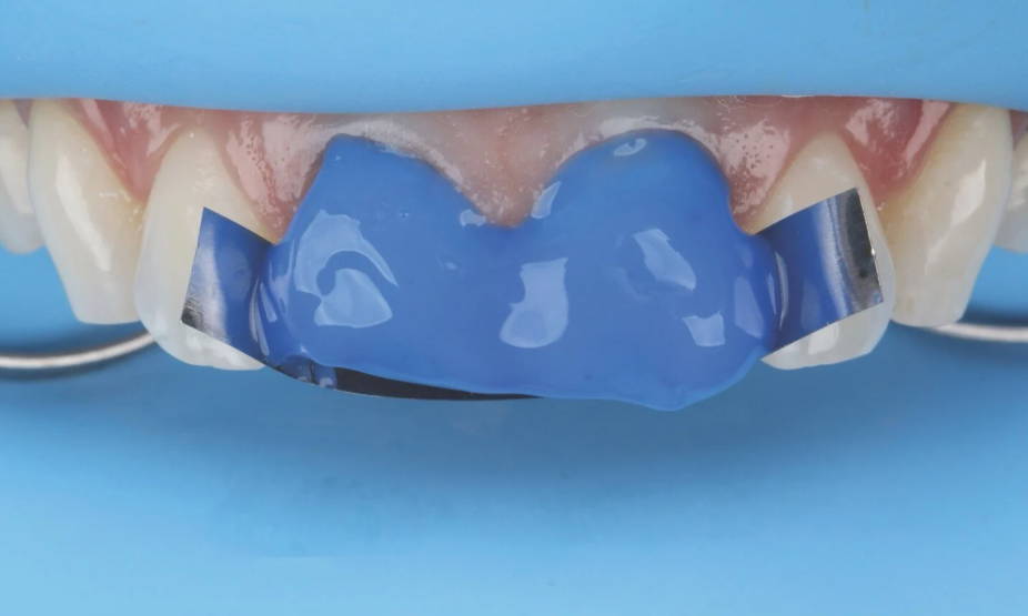 isolated teeth with Ultra-Etch applied