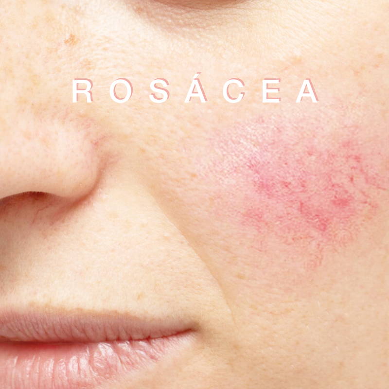 Tengo manchas rojas en la cara. ¿Es rosácea? – Masderm Cosmética