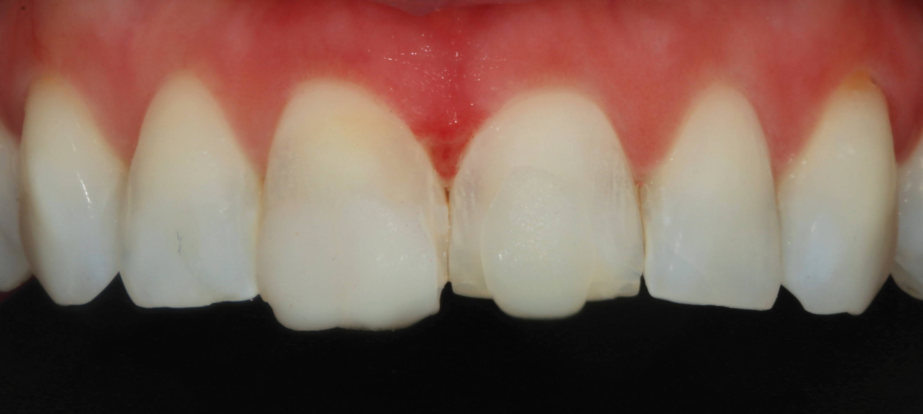 Patient's upper teeth shade matching