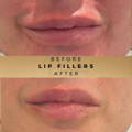 Lip Fillers Wilmslow with Anti-wrinkle injections