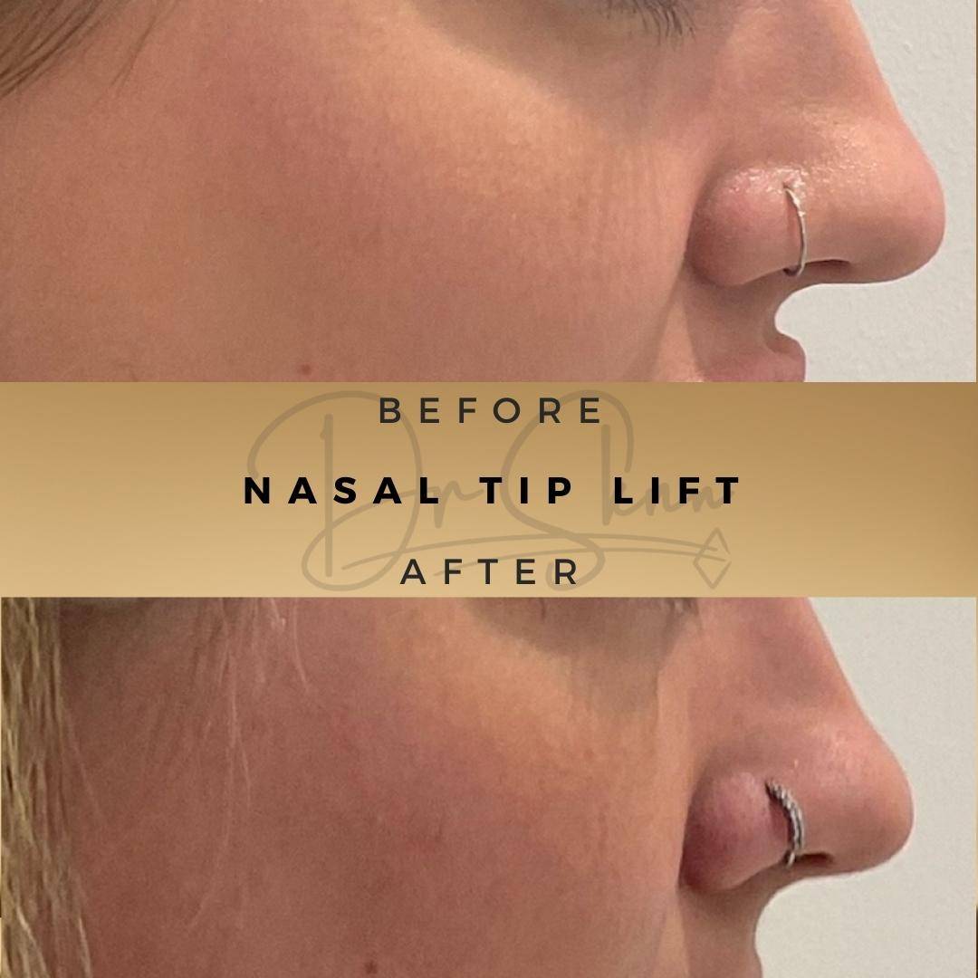 Nasal Tip Anti-Wrinkle Injections Wilmslow Before & After Dr Sknn