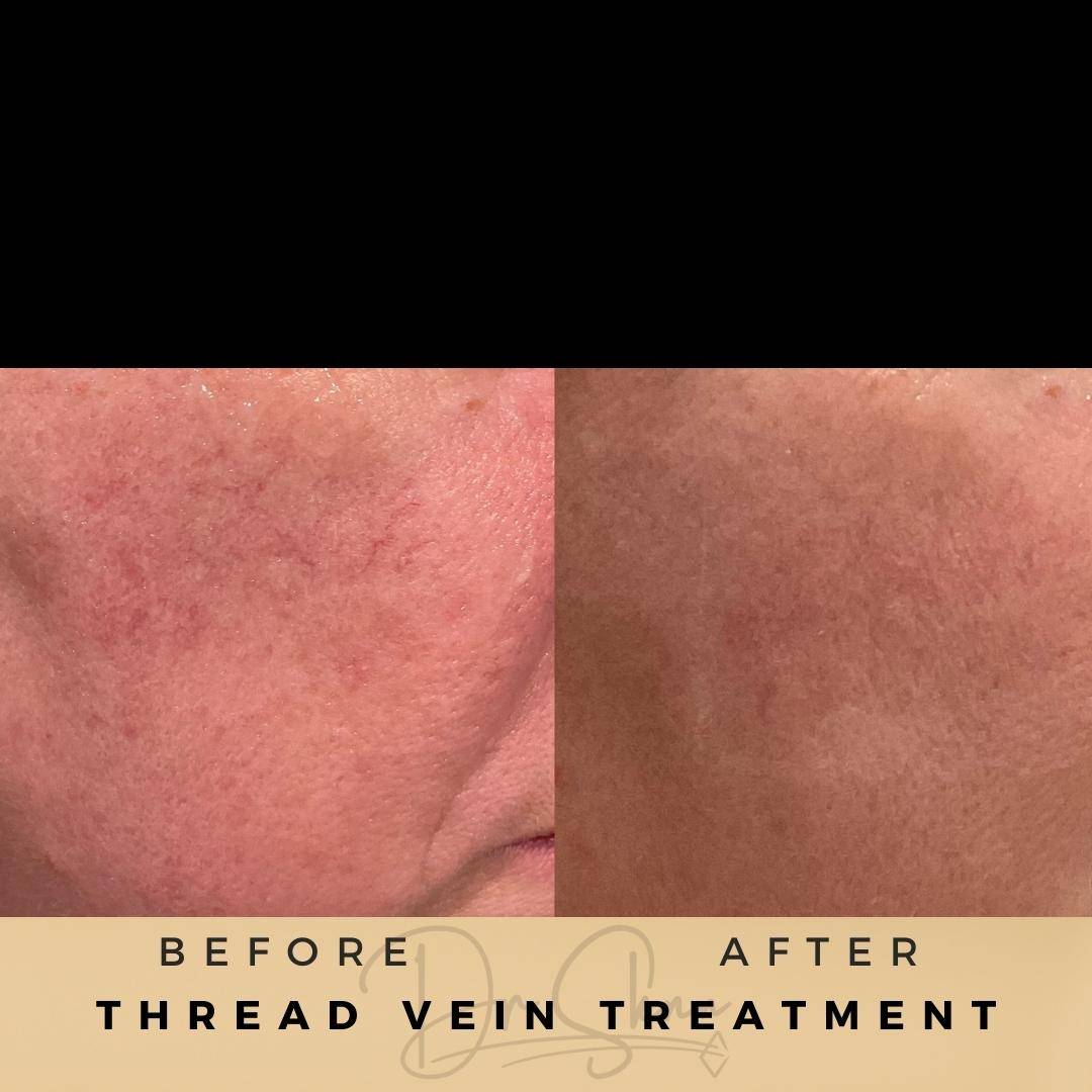 Vascular Lesions - Dr Sknn before and after