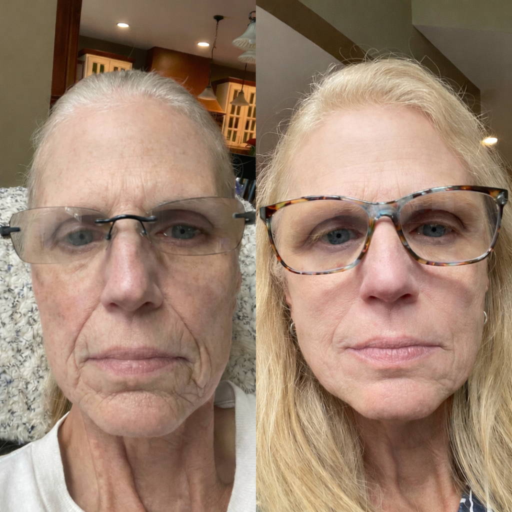 Metamorfoza zmarszczek wokół ust