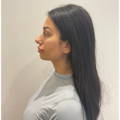 Dermal Fillers - Cheek & Chin Dermal Fillers - Before