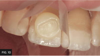 Mylar strips placed in the proximal contacts of central incisors