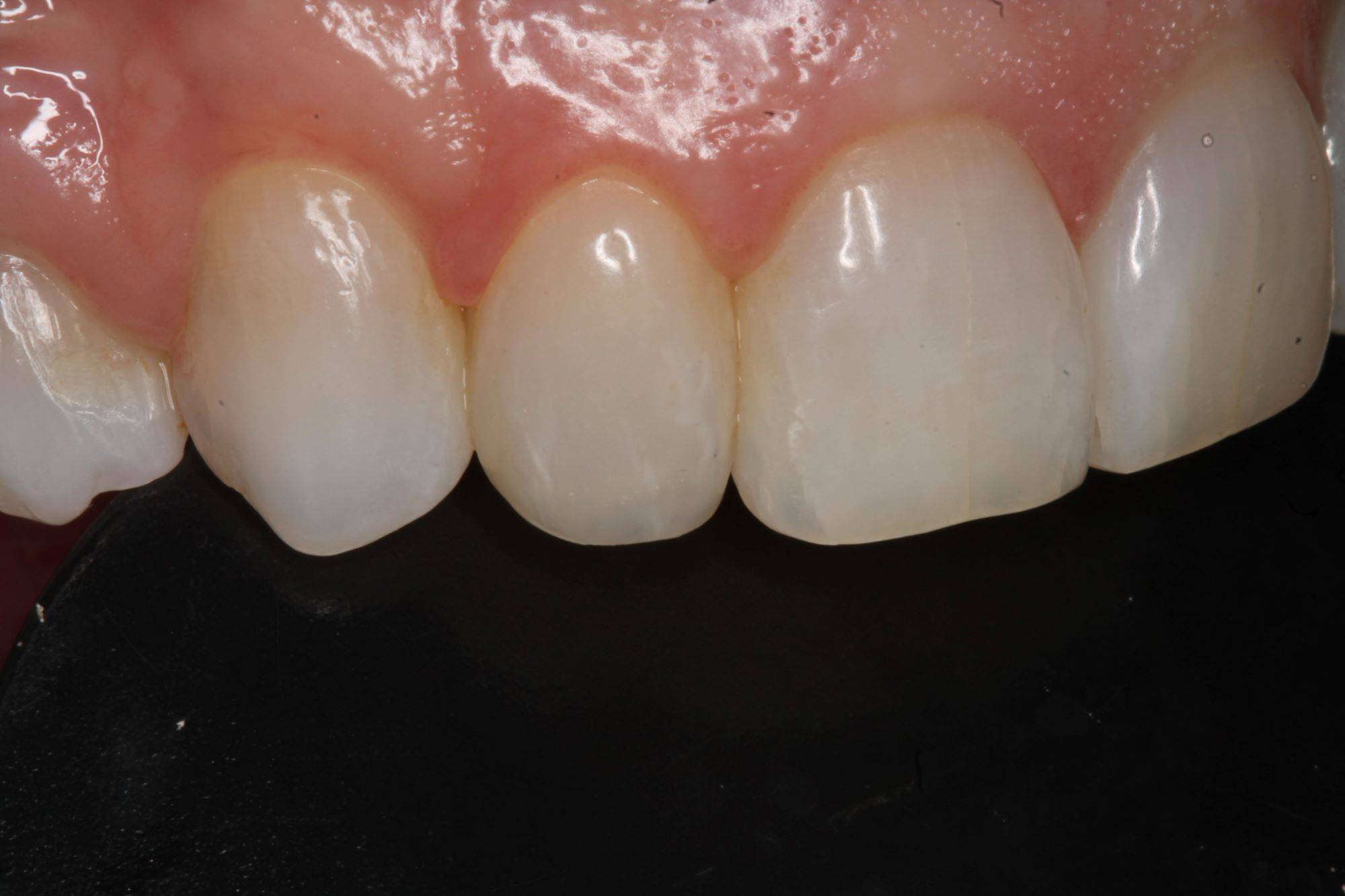 Smile close-up showing even lateral incisor post procedure