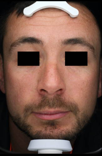 Dr Sknn Personalised Serum Microneedling - Custom Mesotherapy After