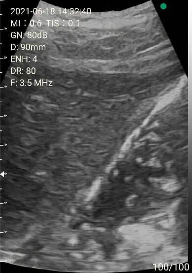 EagleView portable ultrasound image-left lobe of liver