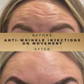 Forehead Anti-Wrinkle Injections Wilmslow
