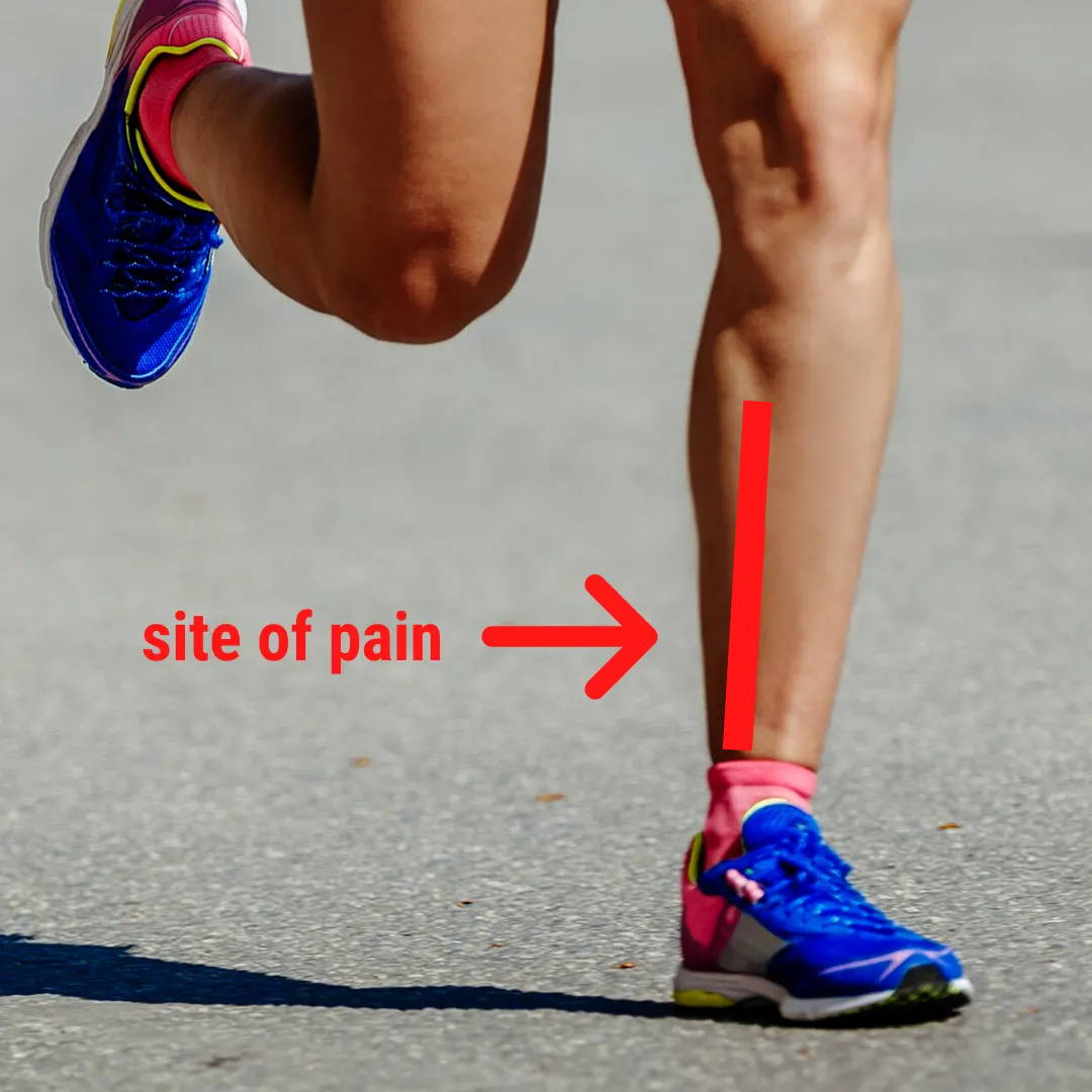 medial tibial stress syndrome