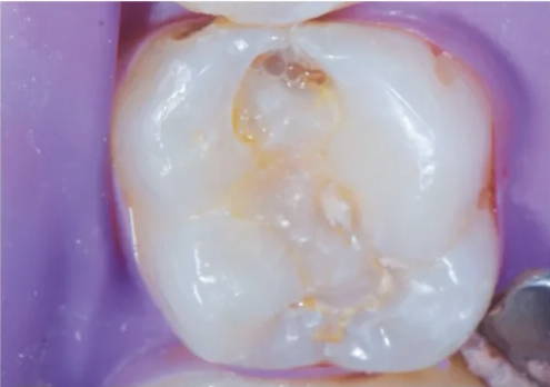 molar with apparent restoration