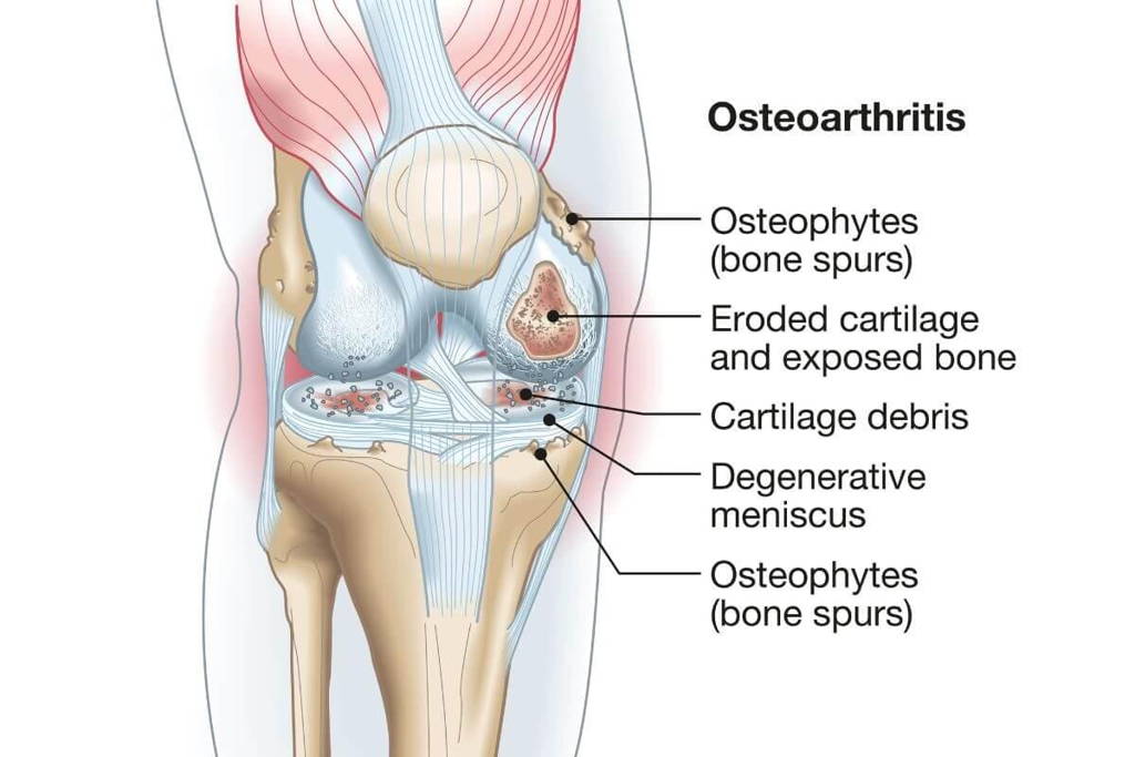 onecompress bamboo, kneesleeve, natural knee pain relief