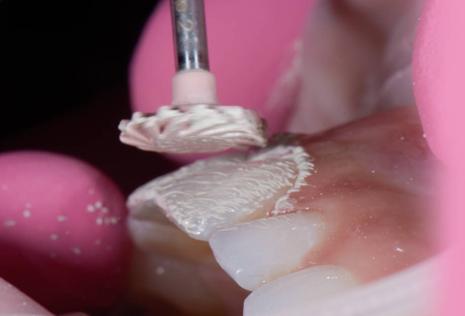 All surface polisher polishing teeth 