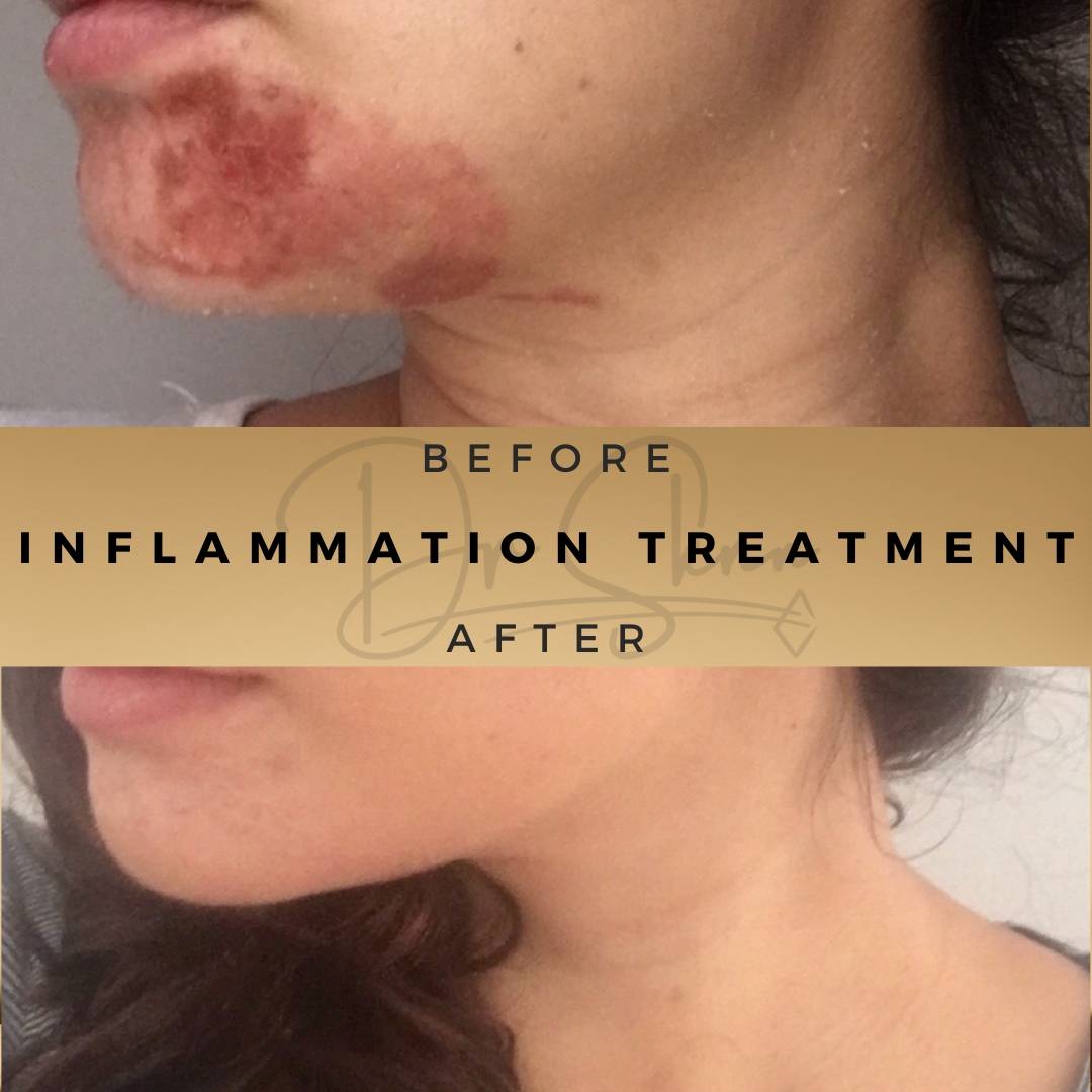 Ezcema & Inflammation Treatment Wilmslow Before & After Dr Sknn