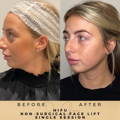 HIFU Wilmslow Non Surgical Facelift Wilmslow Dr Sknn Before & After Picture