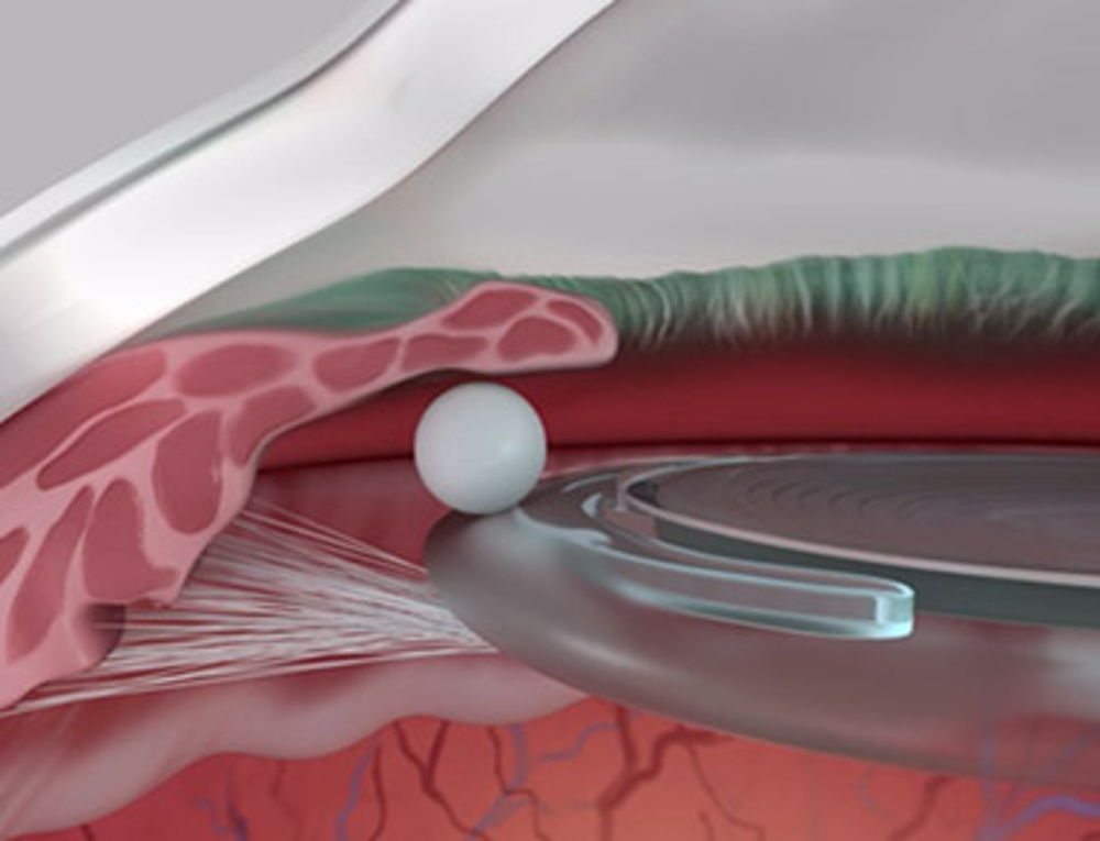Droplet of DEXYCU placed within the eye following cataract surgery