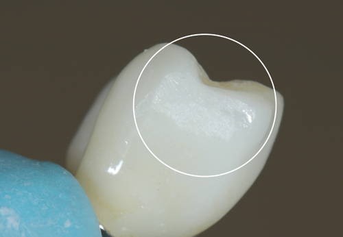white circle highlighting detail on tooth