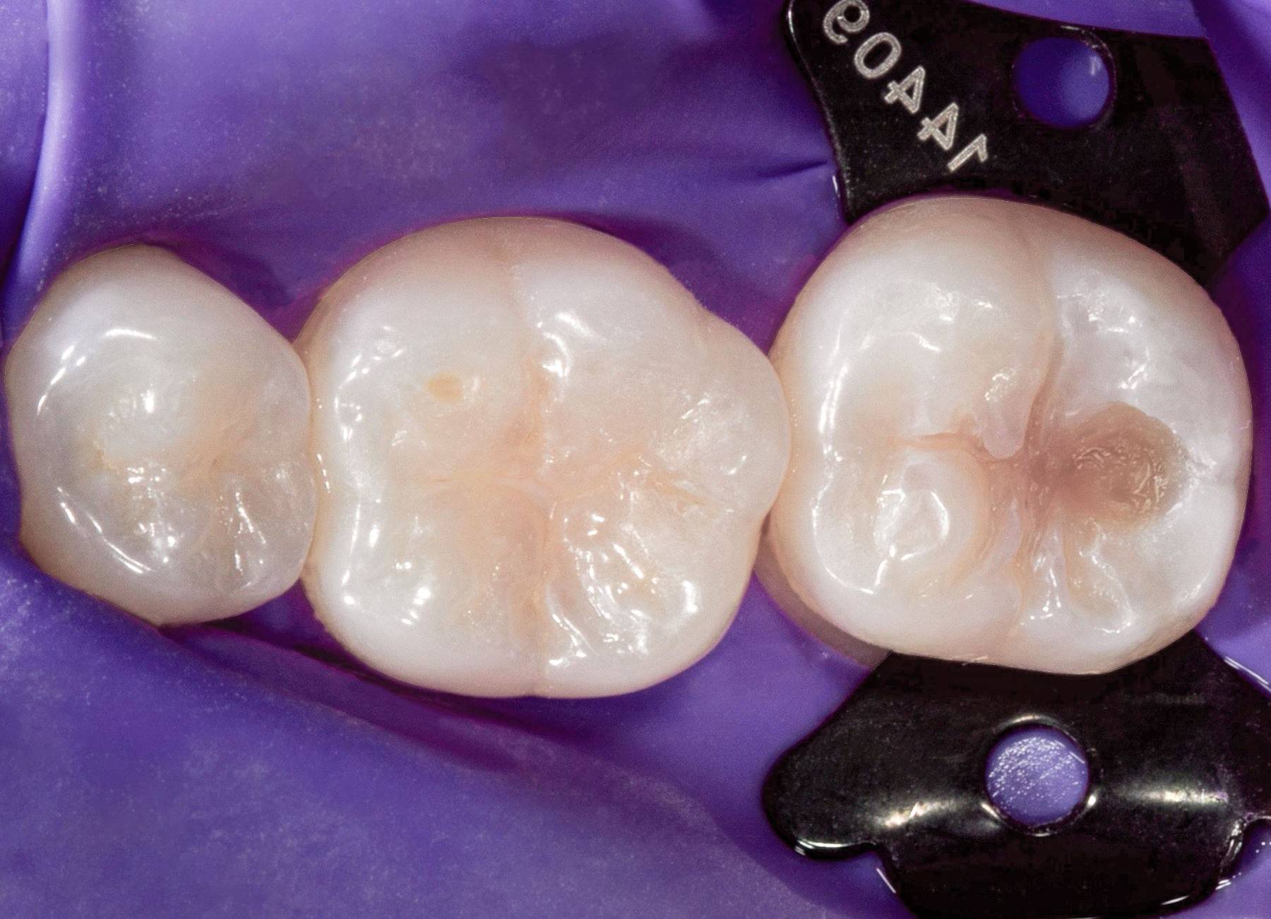 Teeth isolated with purple rubber dam