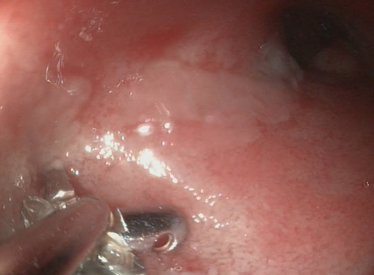 Endoscopie van een ontstoken darmslijmvlies