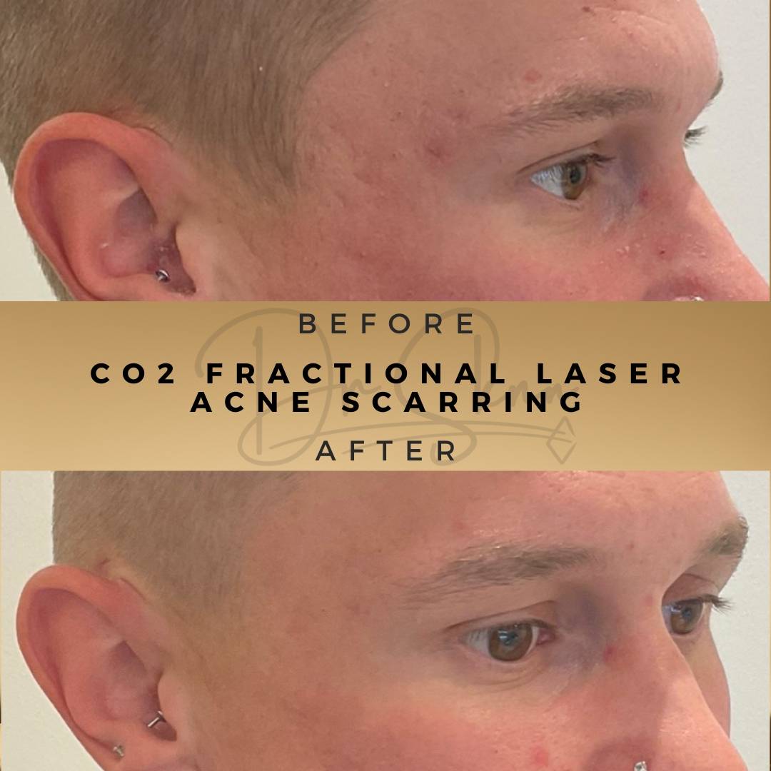 Acne Scarring Laser Treatment Wilmslow Before & After Dr Sknn