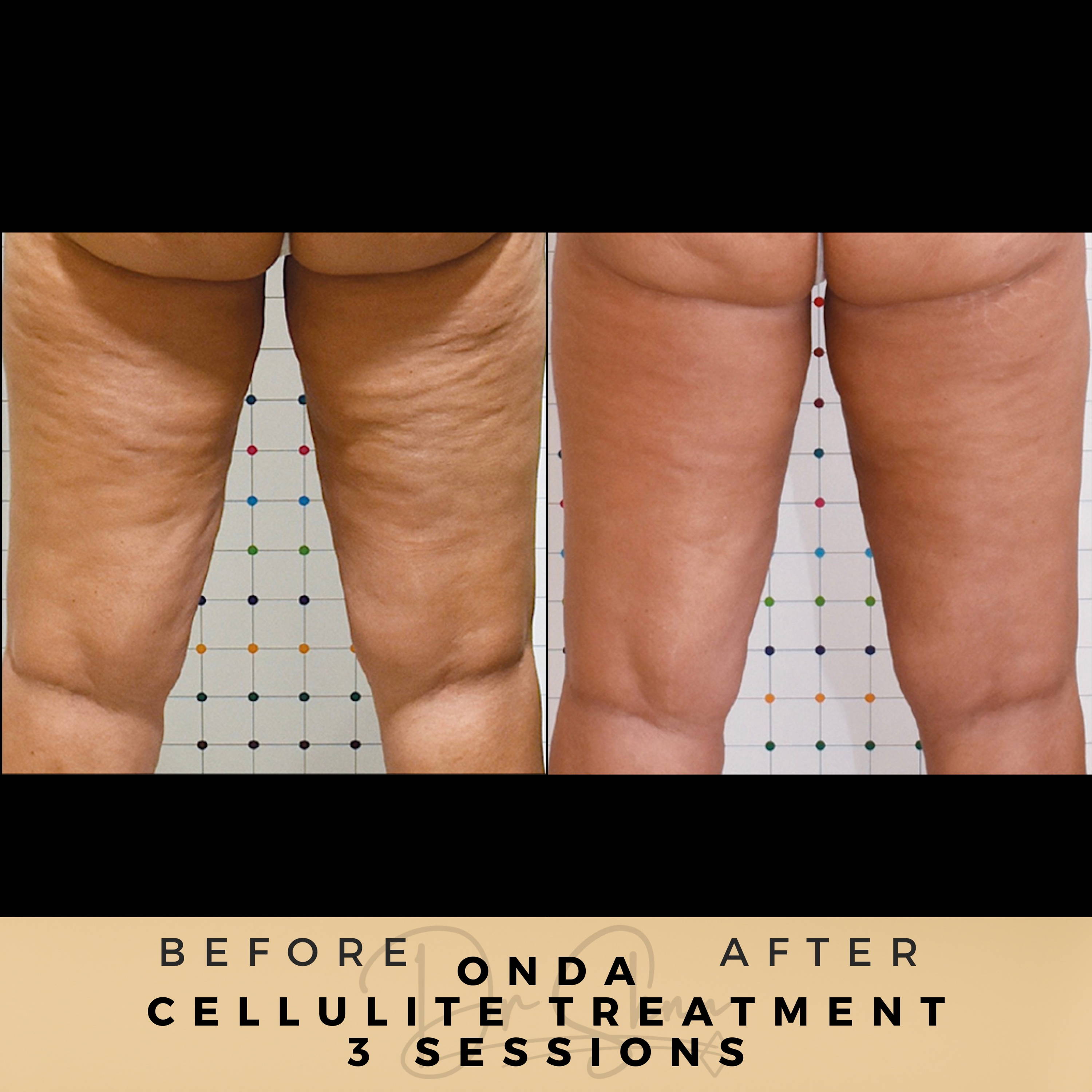 Cellulite Removal - Non-surgical - Dr Sknn before and after