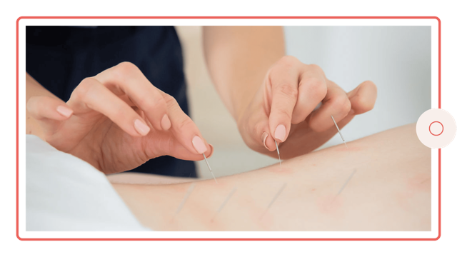 Acupuncture illustration