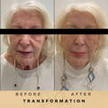 Before & After Pictures Dr Sknn Wilmslow Cheshire