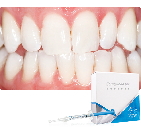 Opalescence Teeth: after teeth whitening with whitening gel with carbamide peroxide
