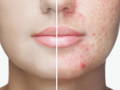 acne on face 