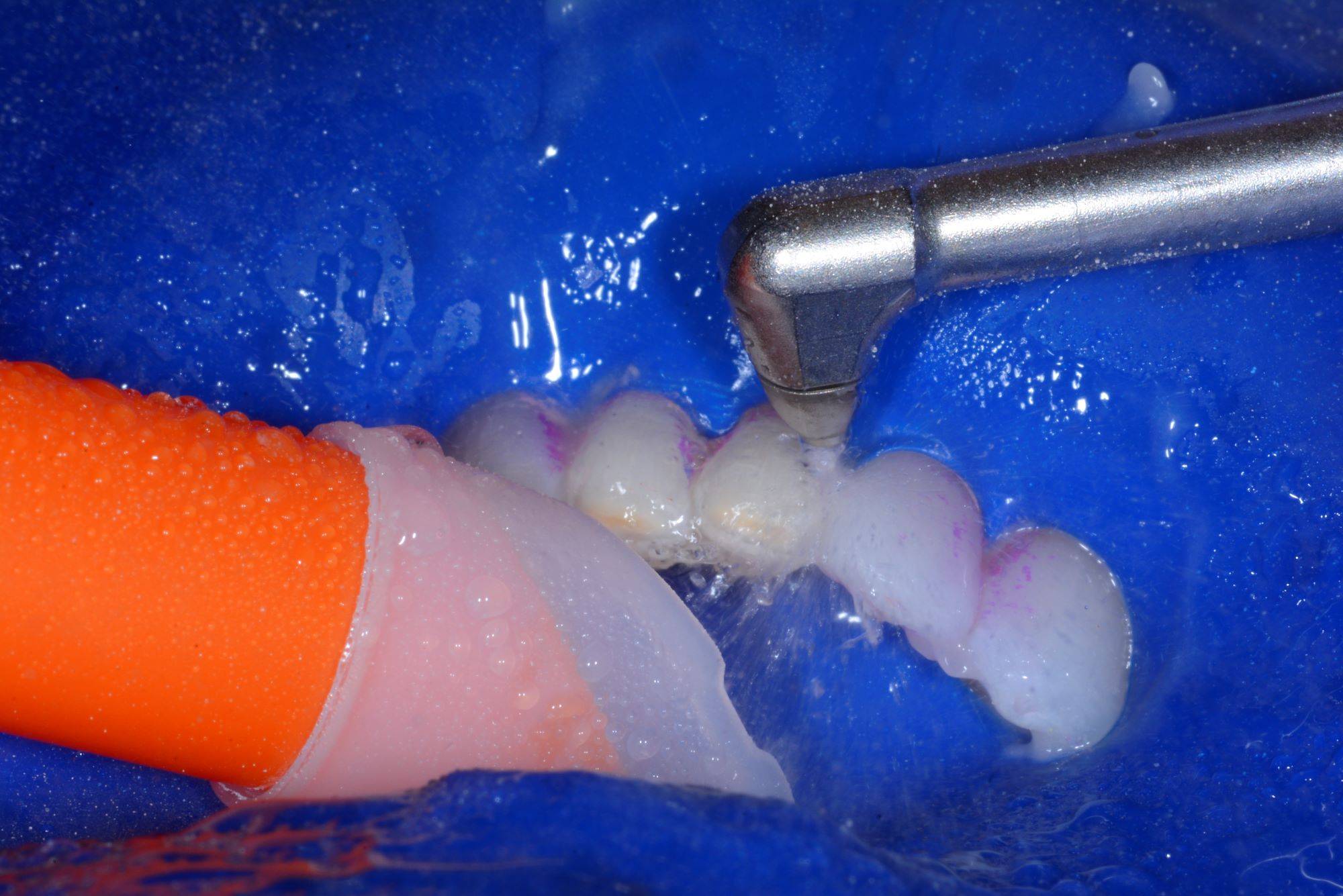 Blaster spraying rubber dam isolated teeth