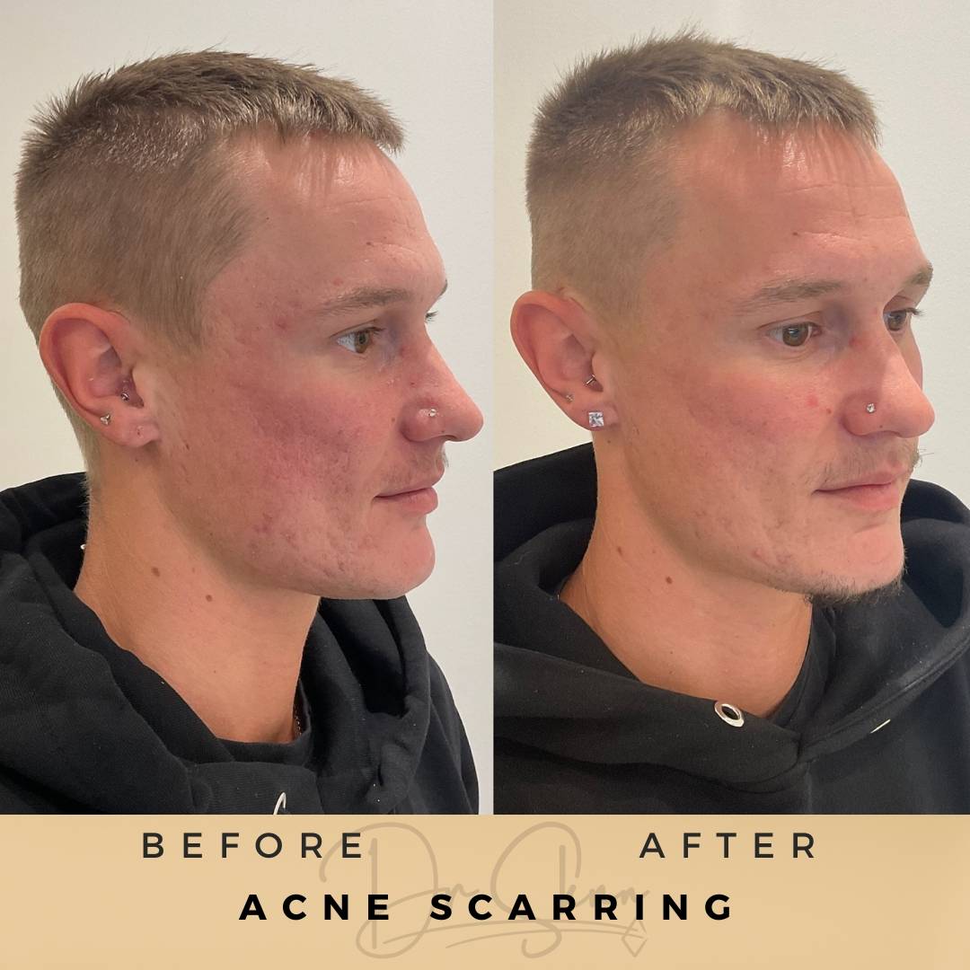 Acne Scarring Treatment Wilmslow Before & After Dr Sknn