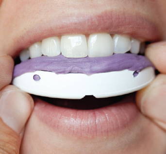 Quicksplint tray filled with purple material approaching upper teeth