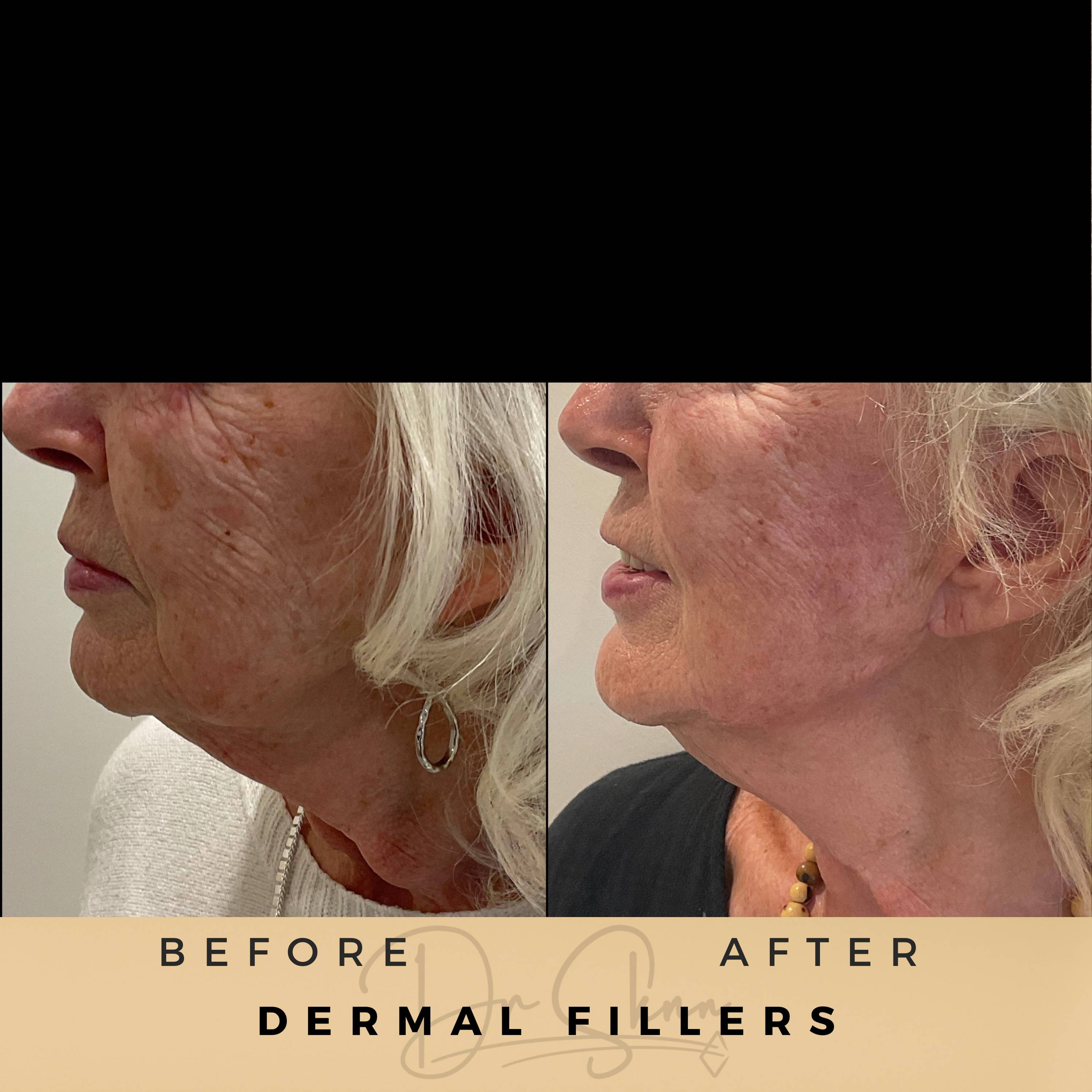 Jawline Fillers Wilmslow Before & After Dr Sknn