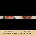 Gummy Smile Correction Fillers Before & After