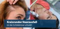 Kreisrunder Haarausfall Schilddrüse