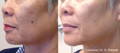 Woman's cheek before and after Lumecca IPL for pigment