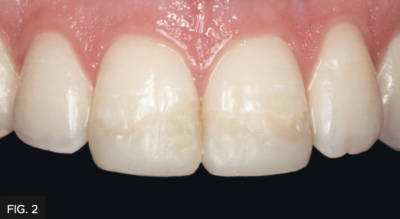 smile showing traumatized anterior teeth