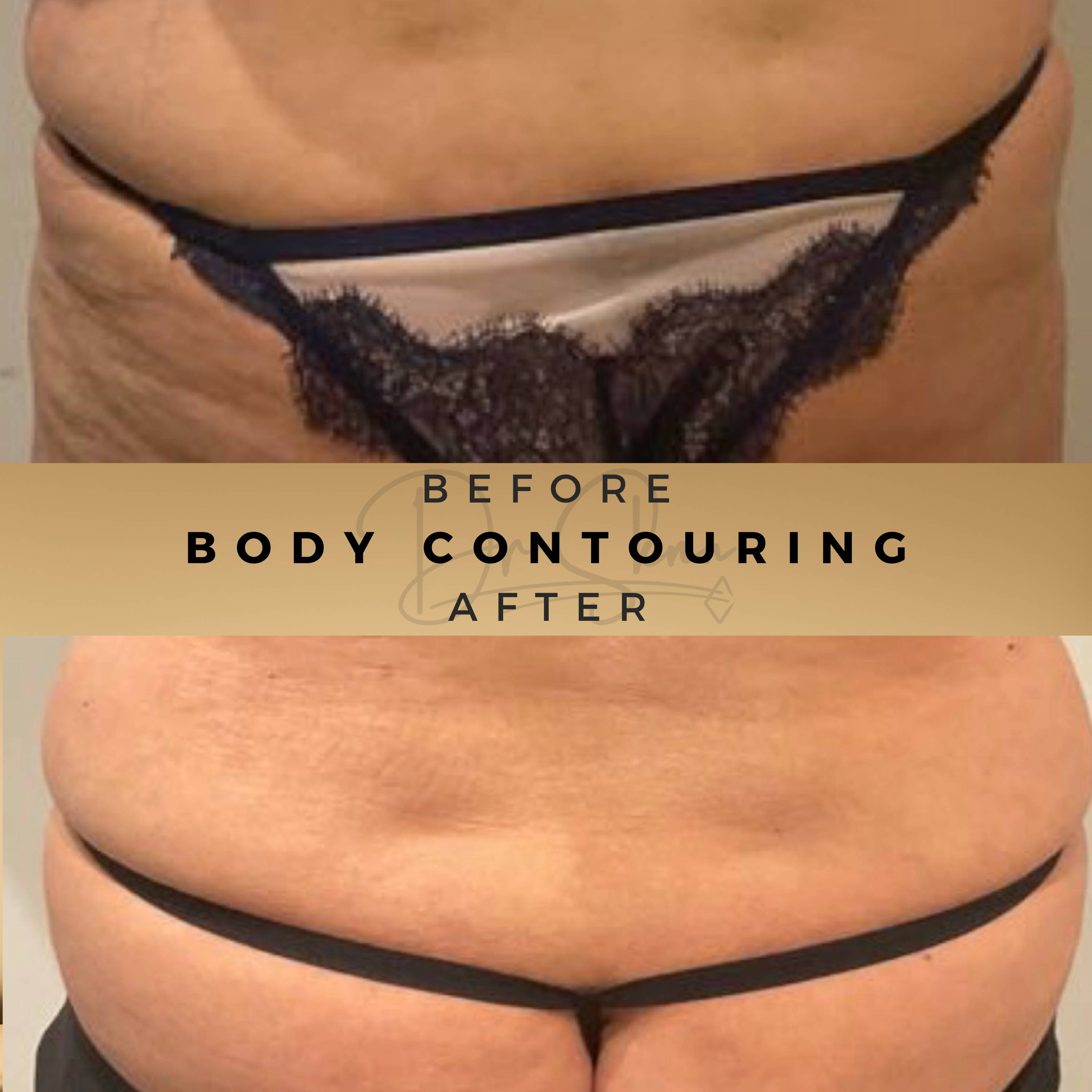 Non Surgical Body Contouring Wilmslow Before & After Dr Sknn