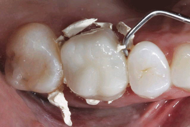 Molars with temporary resin