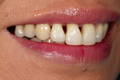Close-up lateral smile showcasing severe black triangles in upper incisors