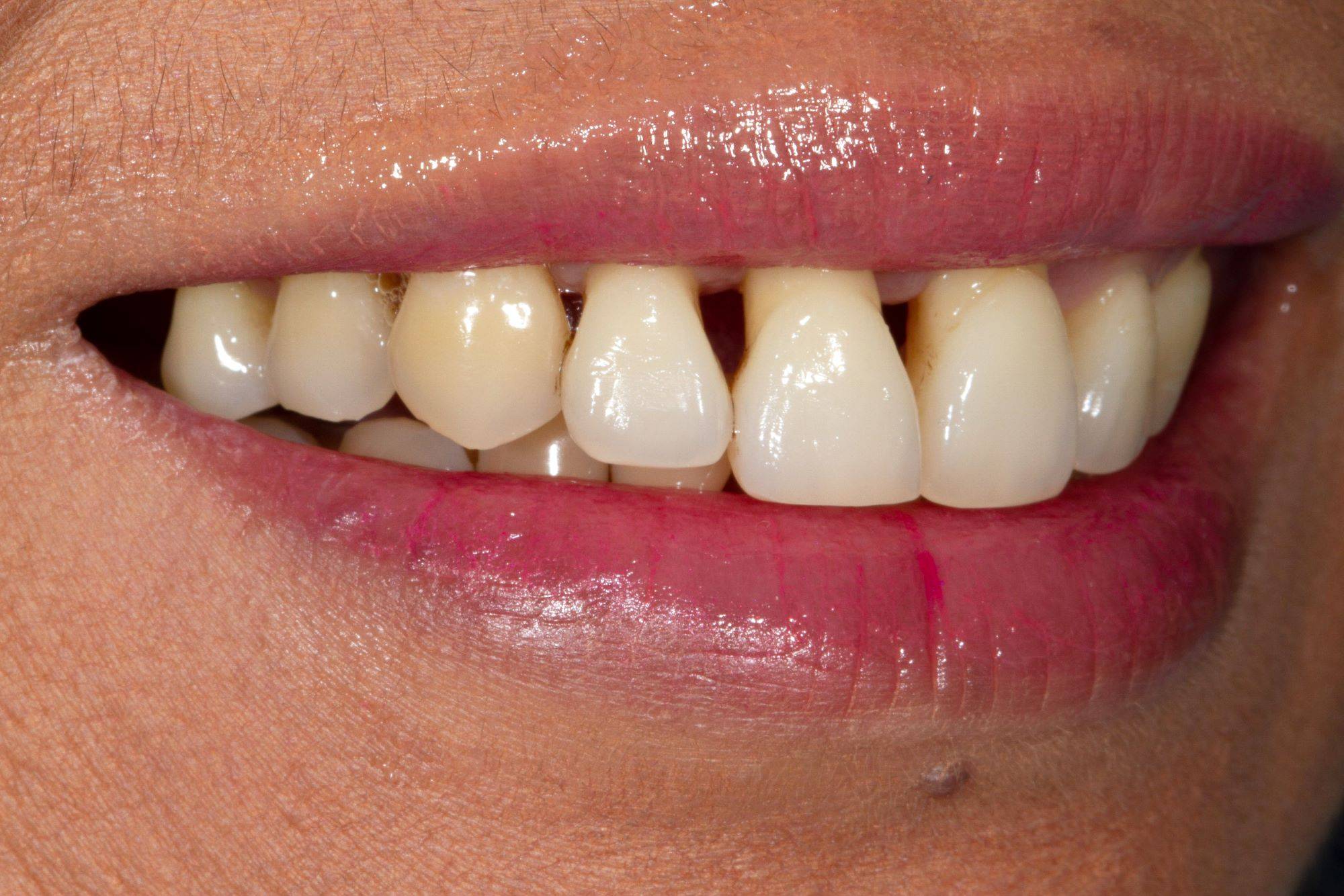 Close-up lateral smile showcasing severe black triangles in upper incisors